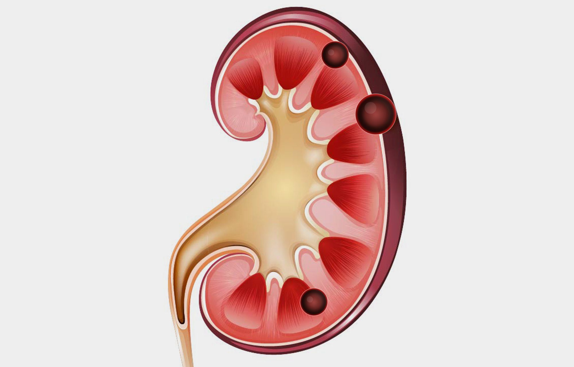 Cisto Renal
